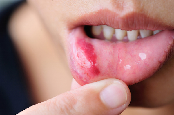 Causes, treatment, and prevention of canker sores