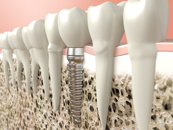 dental implant without peri-implantitis