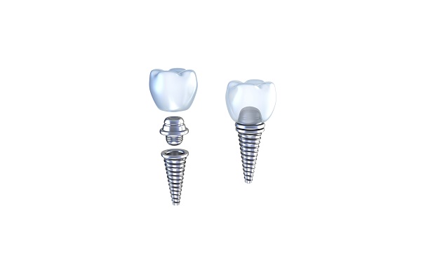 Dental Implants and You