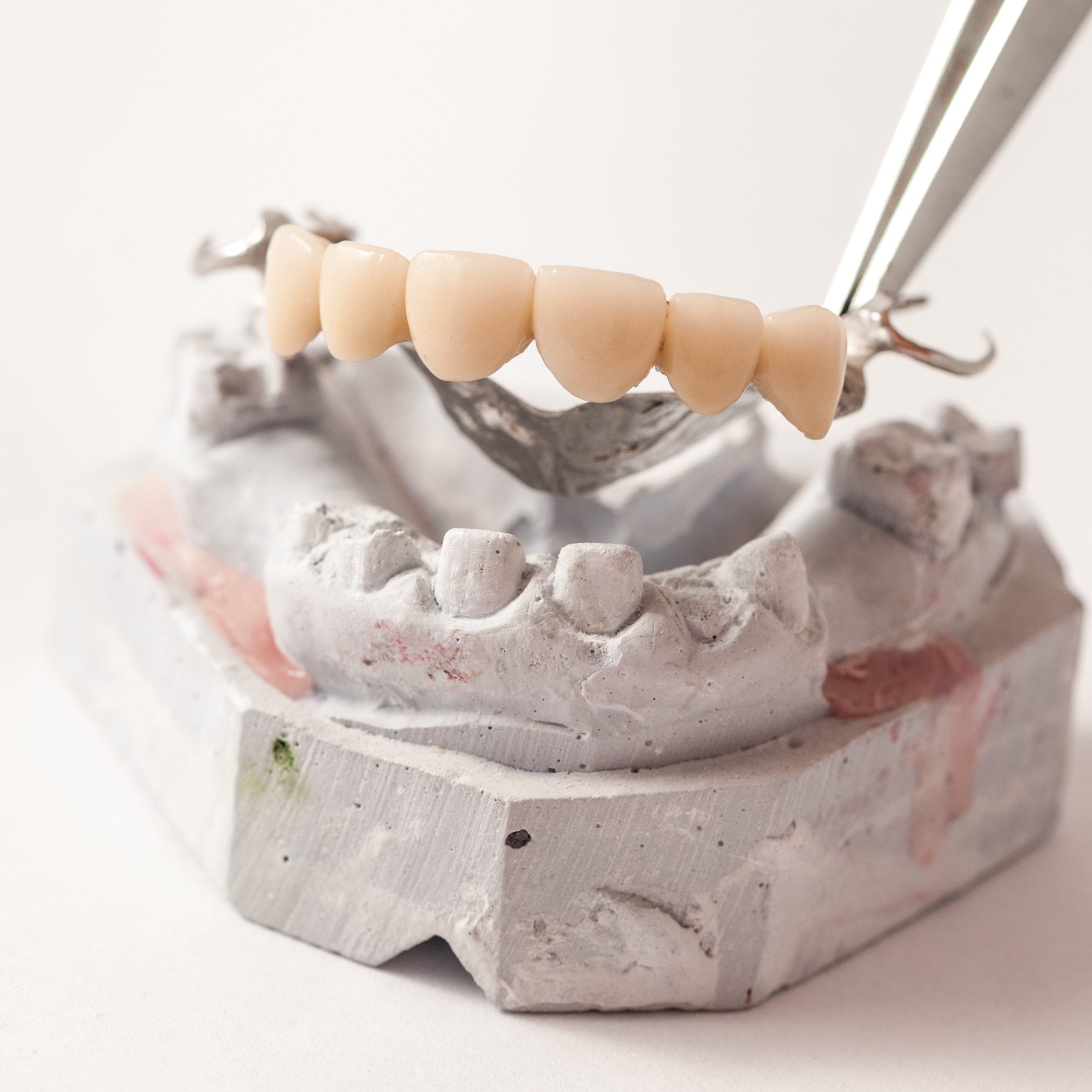 Bridging the Gap: Understanding Dental Bridges