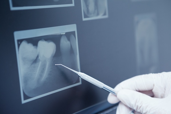 The History and Benefits of Dental X-ray Imaging