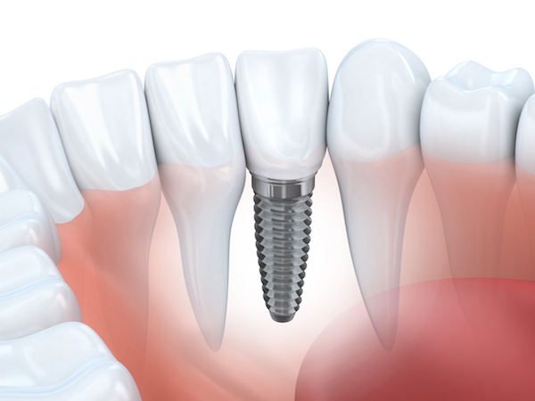 Considering Dental Implants? Here’s What you Should Know