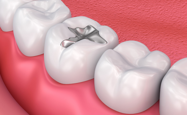 Amalgam vs Composite Fillings: Choosing a Dental Filling Material