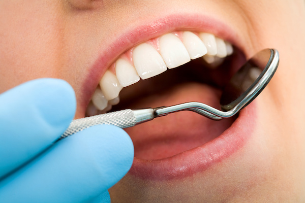 7 Benefits of Composite Resin Fillings