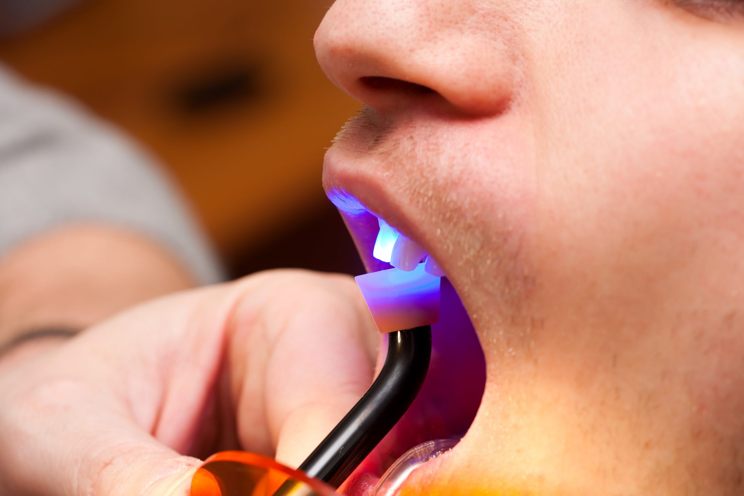 All About Dental Bonding