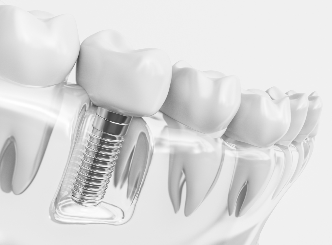 Dental Implant Procedure