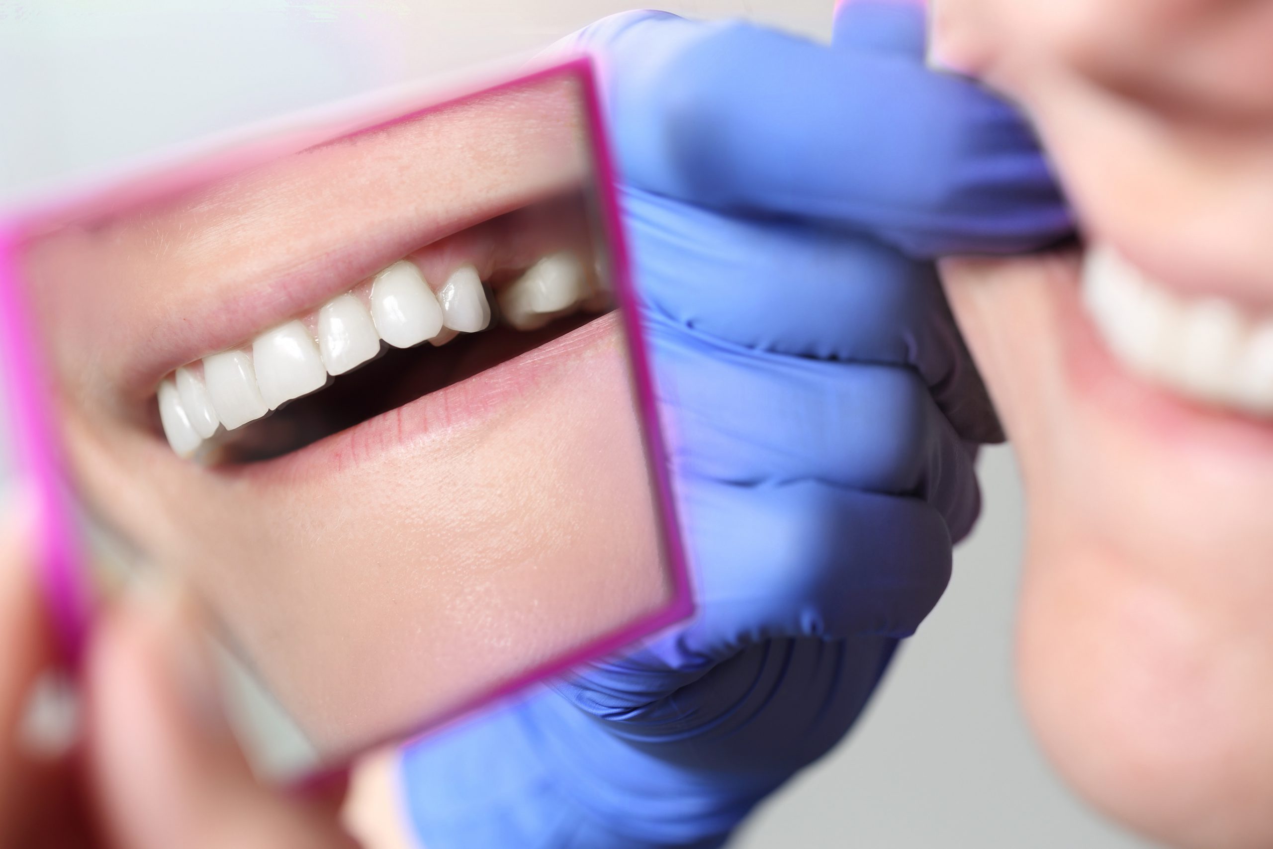 Dental Bridge