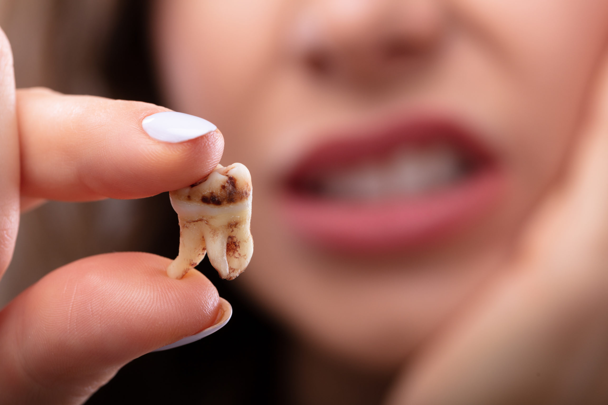 What Is The Leading Cause of Tooth Decay?