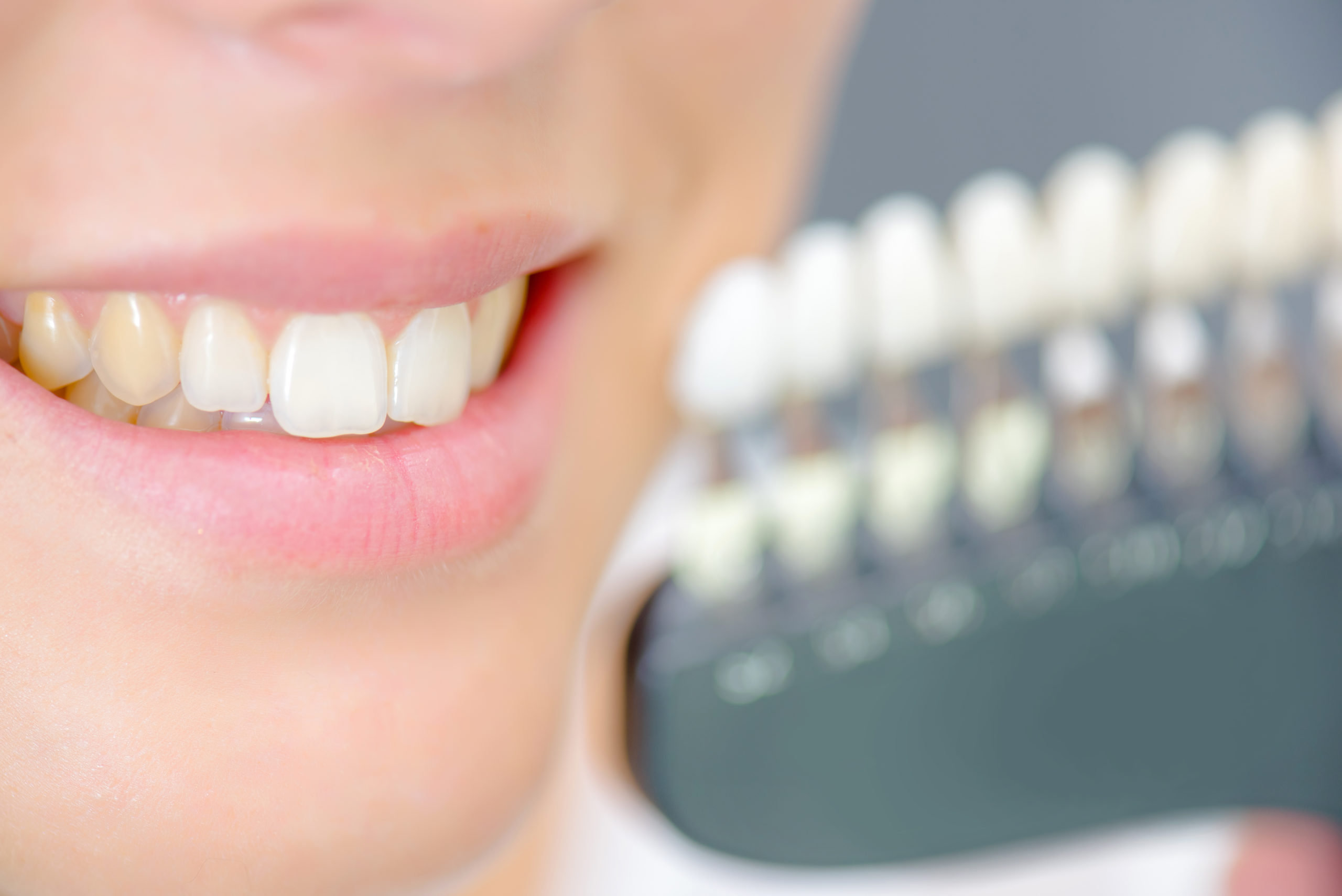 Causes of Tooth Staining: How Do They Get Yellow Stains?