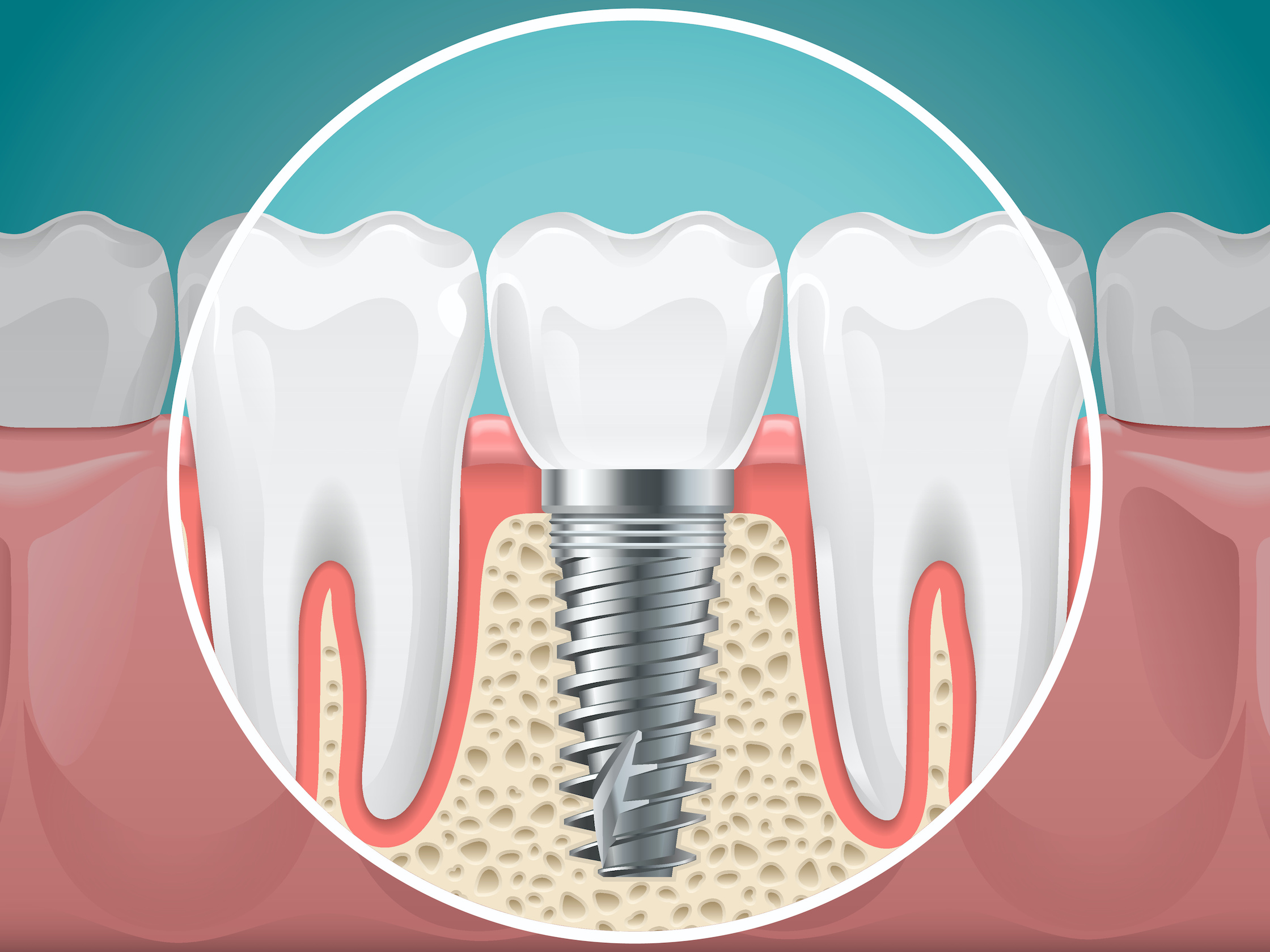 Dental Implants
