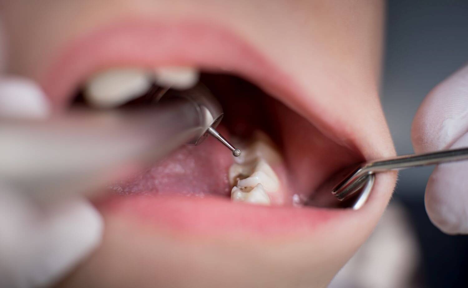 Melbourne Florida Dentist Explains How to Fix a Cavity