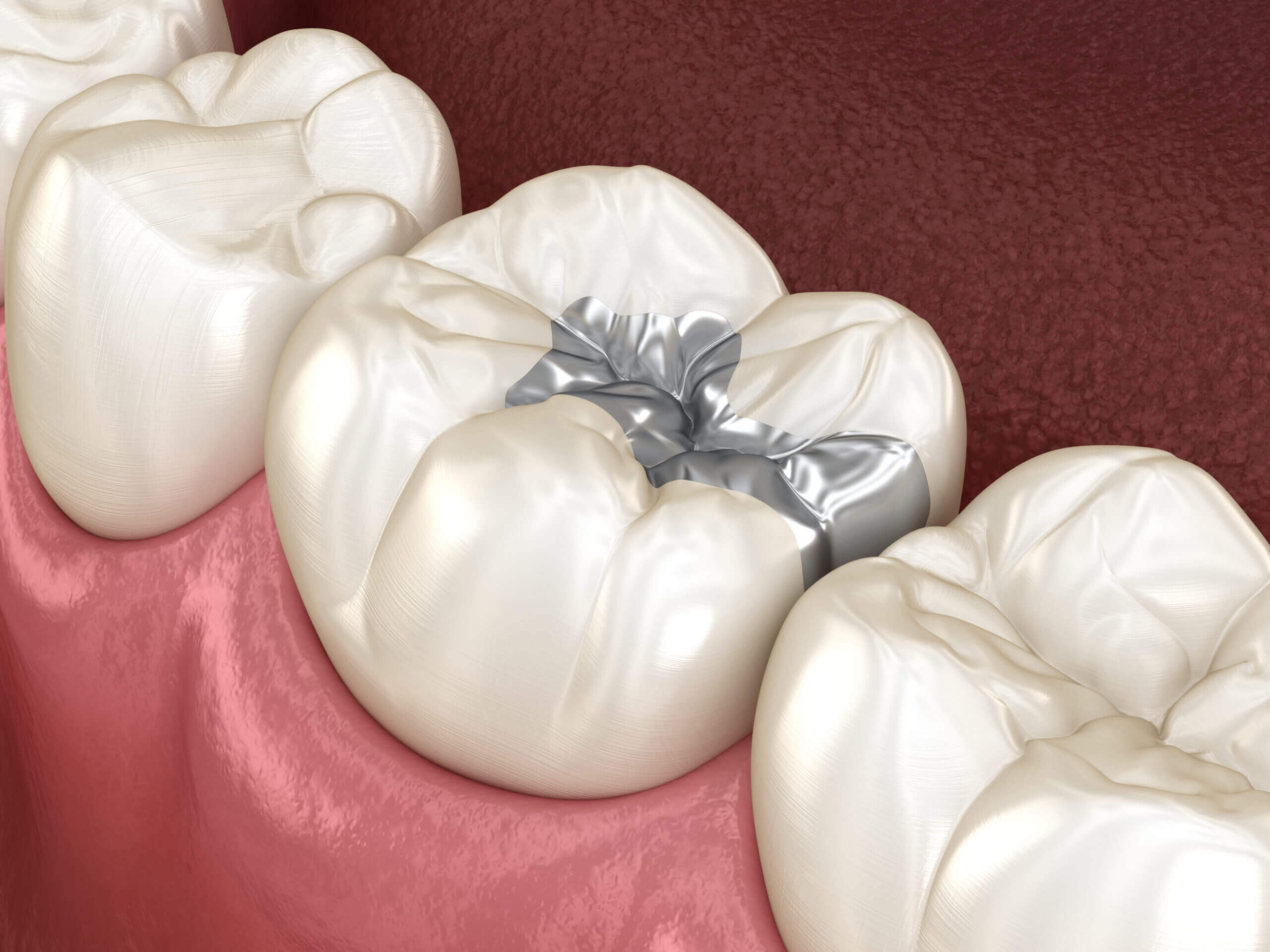 silver fillings white composite fillings patient need