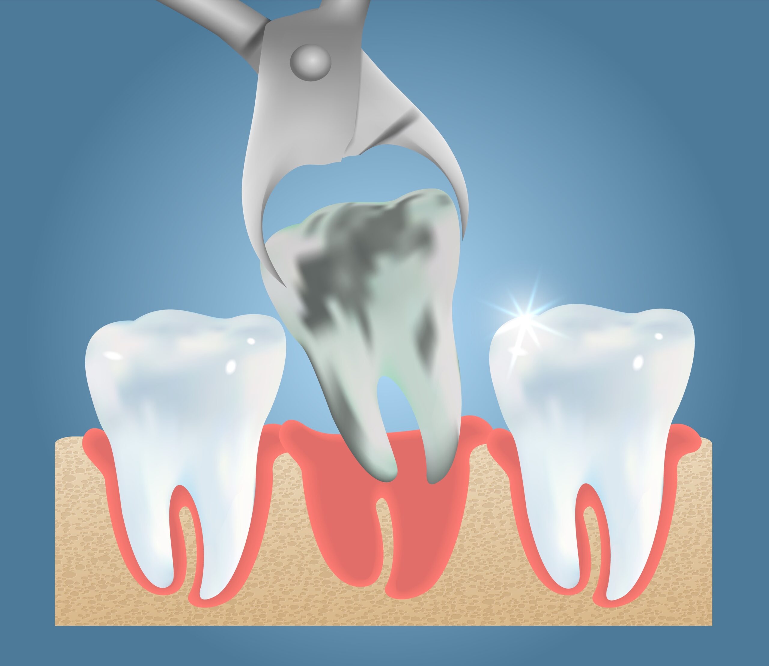Extraction mouth surgery oral surgeon