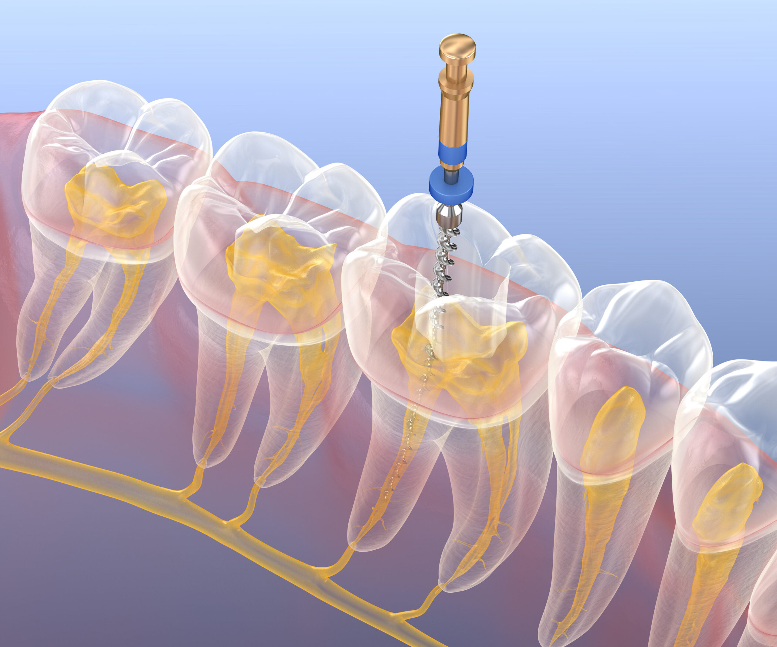 Teeth treatment root canal