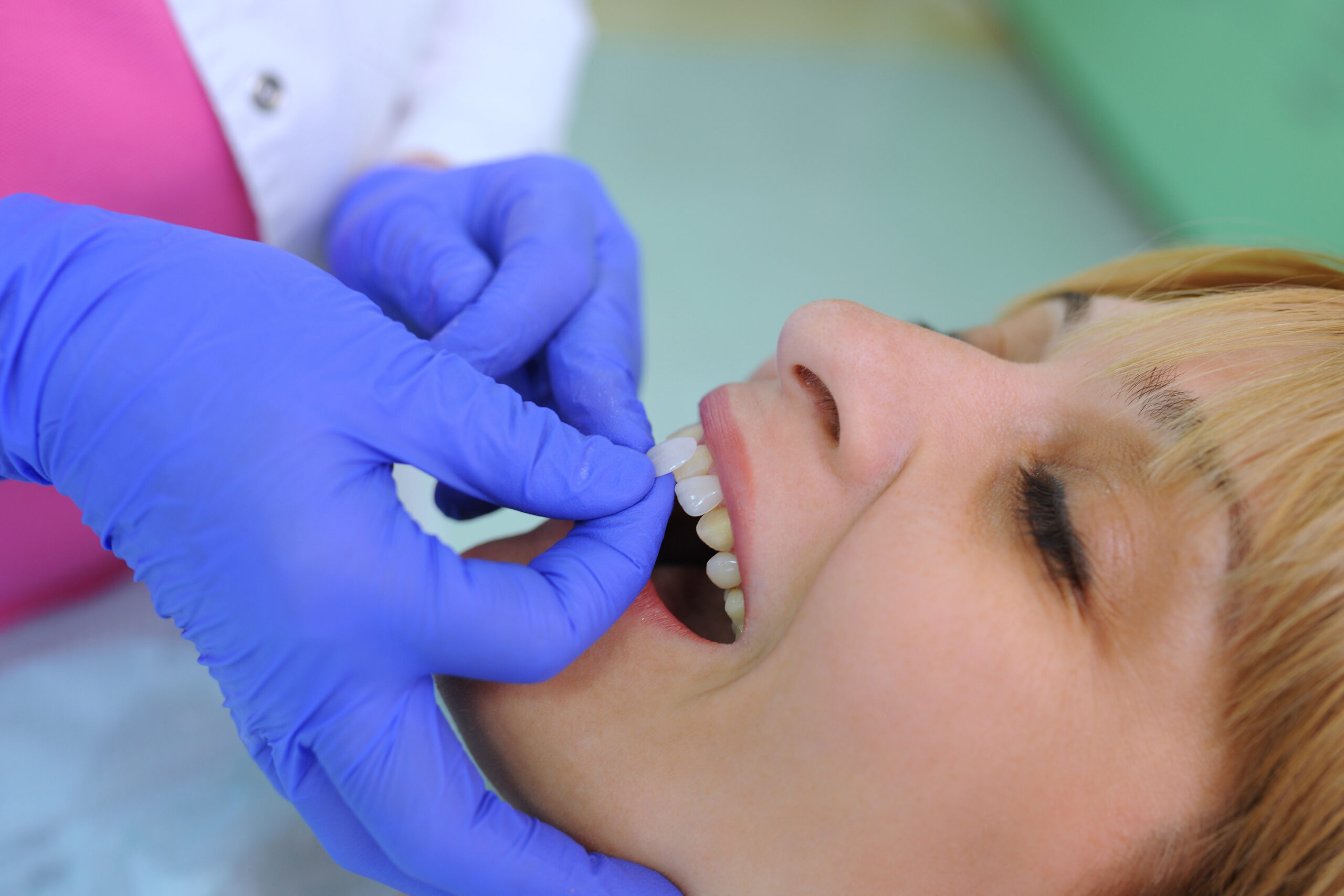 Veneers oral implants