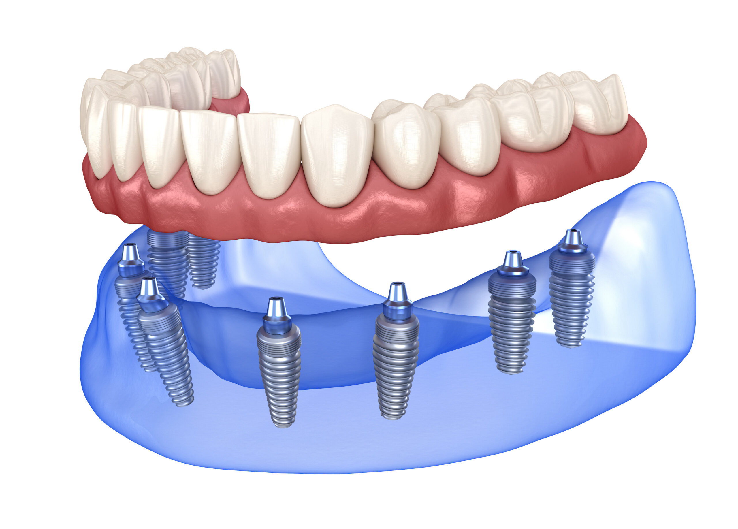 Implants dental health oral health detist support teeth oral tooth