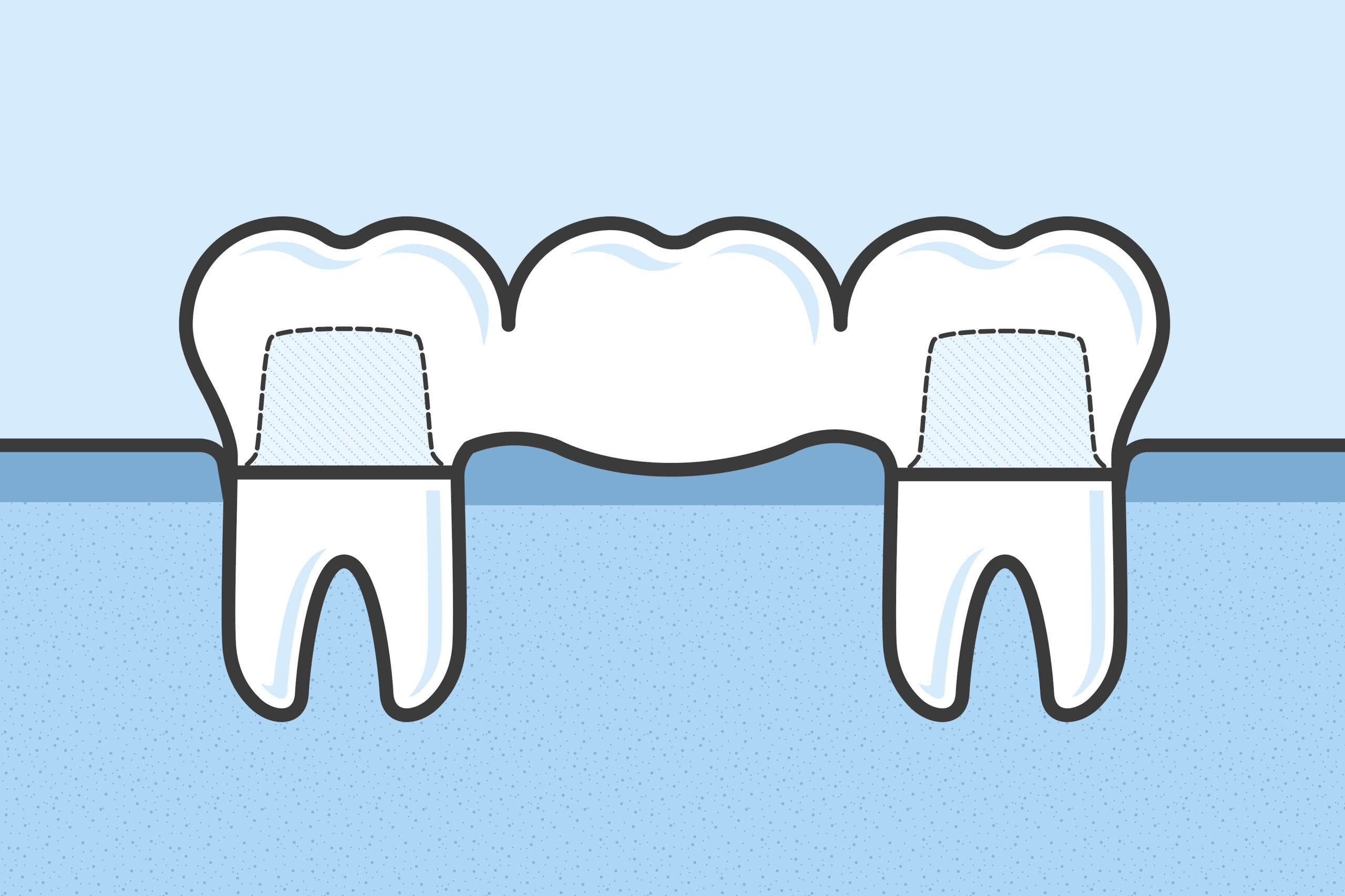 Dental Bridge implants