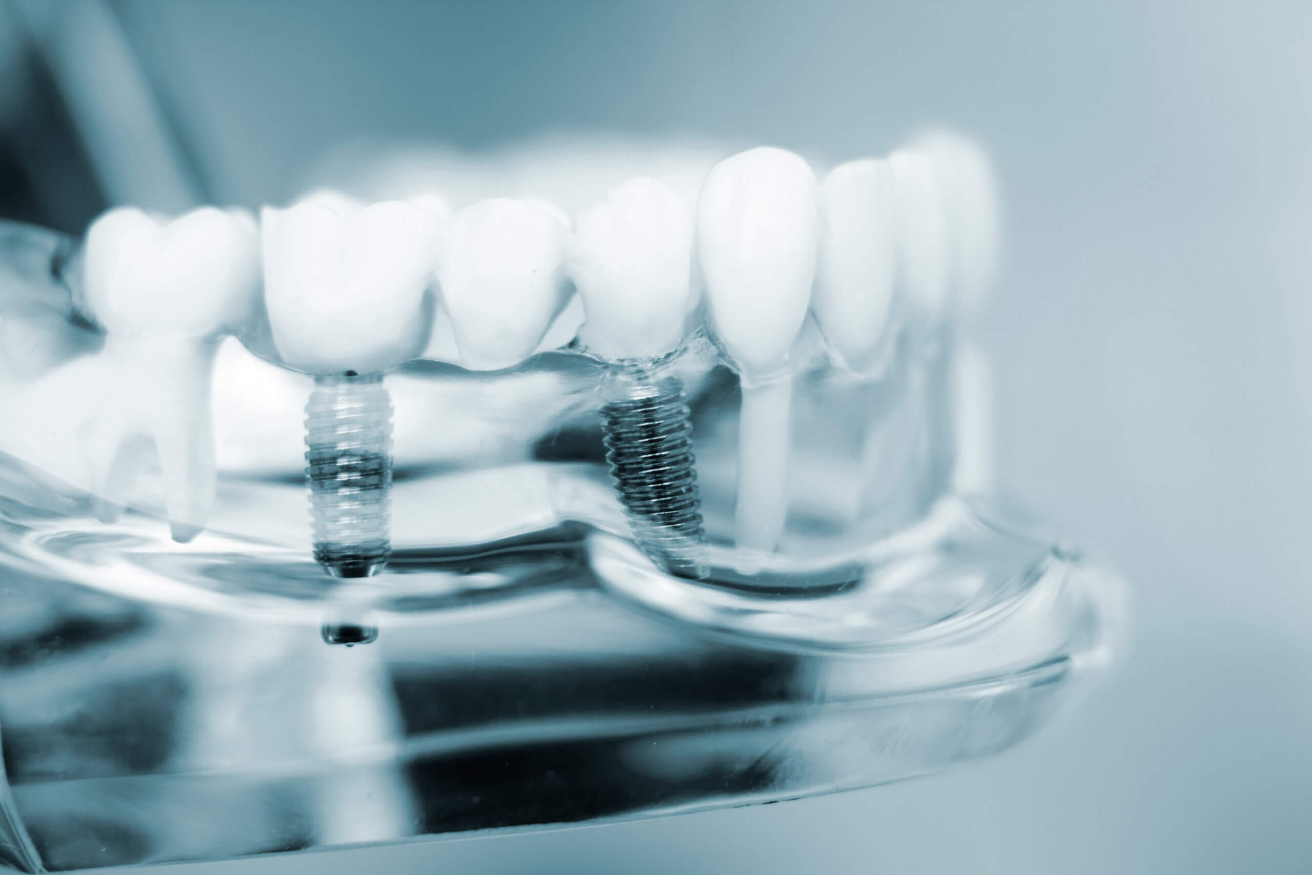 Bridge vs. Implant: Deciding Between Two Tooth Replacement Options