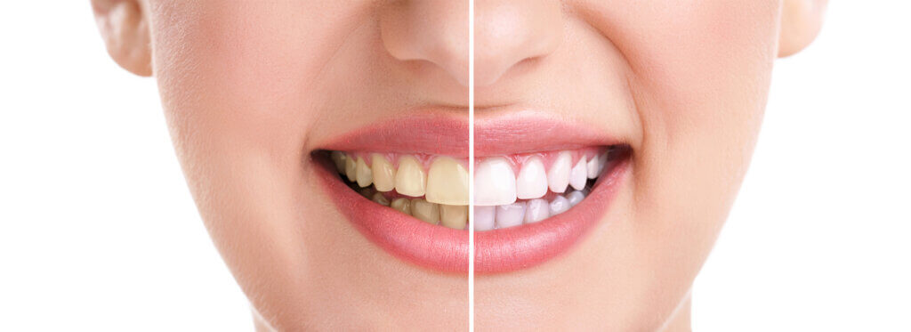 KoR whitening teeth whitening Melbourne