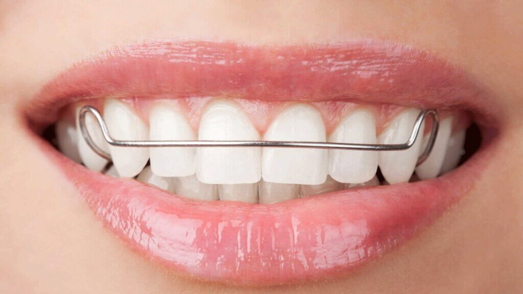 orthodontic retention Melbourne dentist retainers