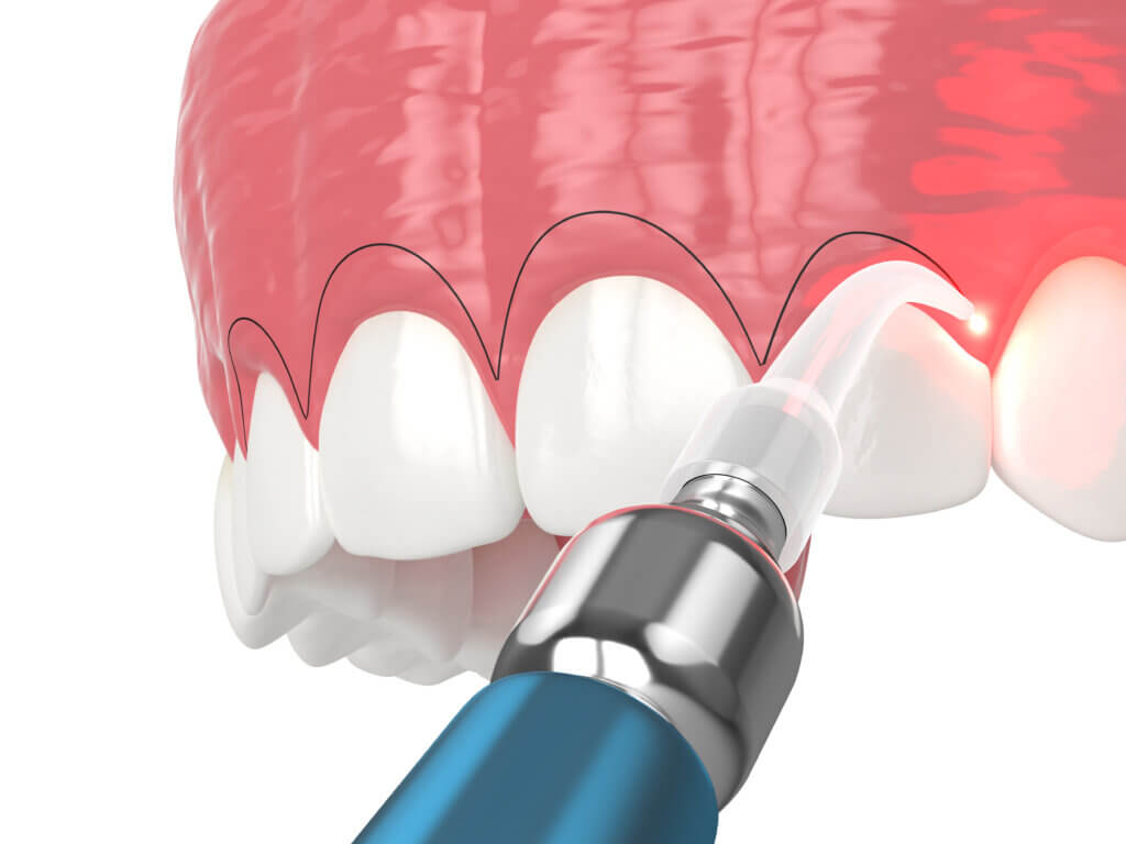 Gum Contouring and Reshaping cosmetic dentist west melbourne