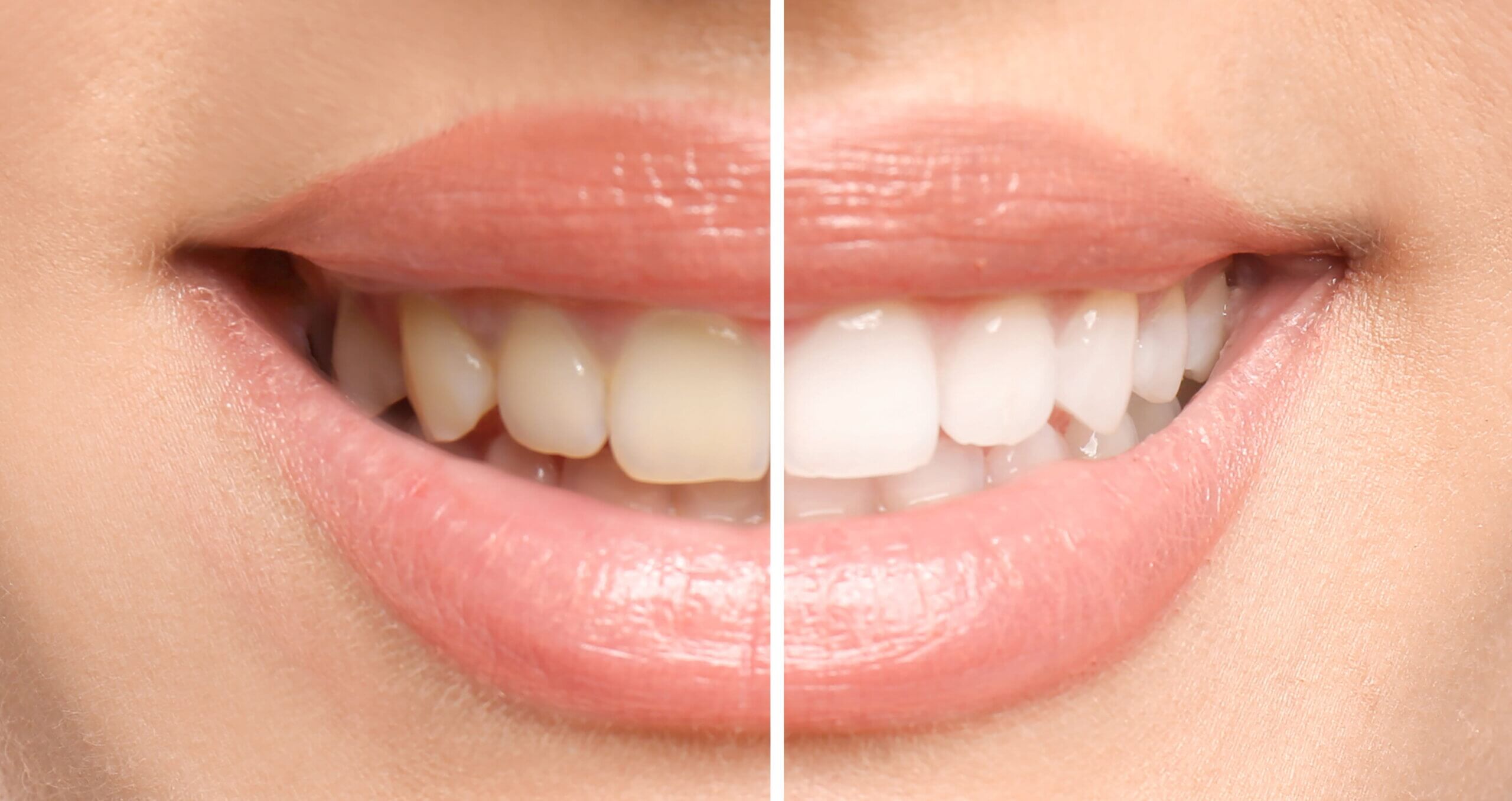 Teeth Whitening Maintenance: How to Keep Results Longer