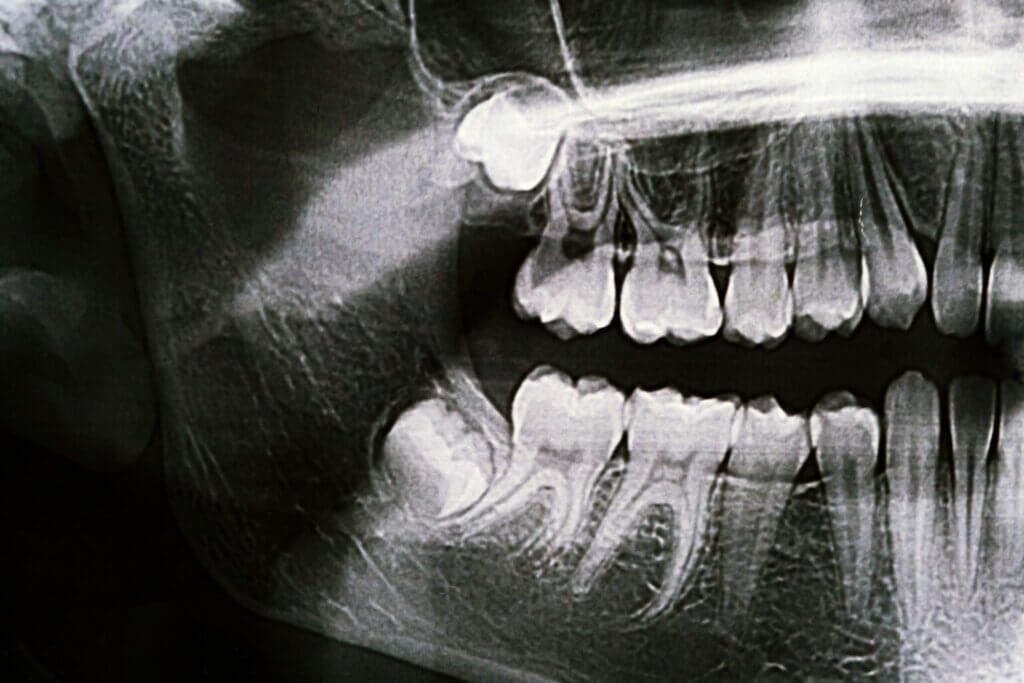 wisdom teeth removal dentist melbourne