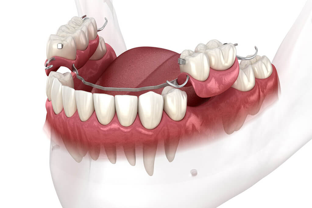 removable partial dentures Melbourne FL dentist