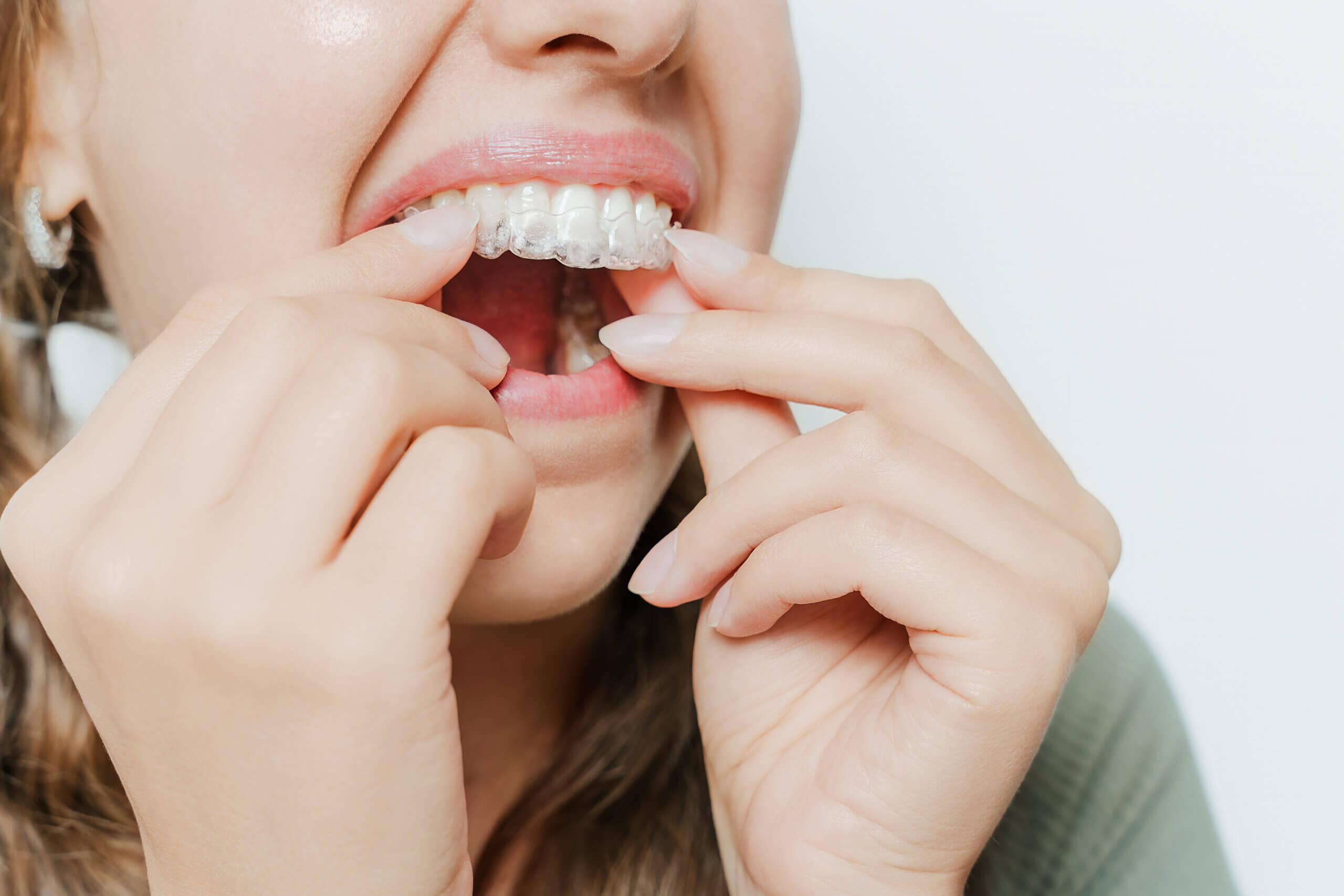 Is Invisalign Near Me Worth Considering?